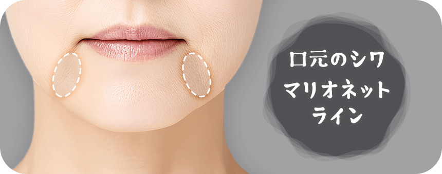 口周りのシワやマリオネットライン