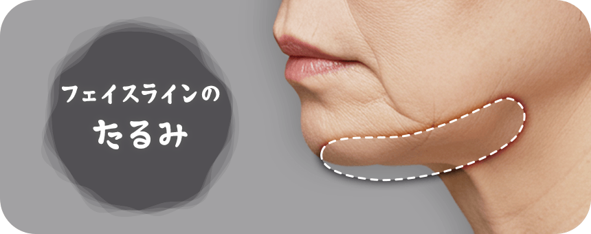 お顔の輪郭のたるみ