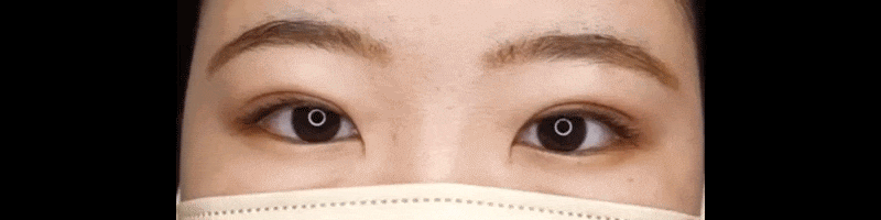 当院一番人気の埋没法!