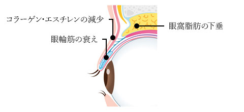 上まぶたのたるみの原因