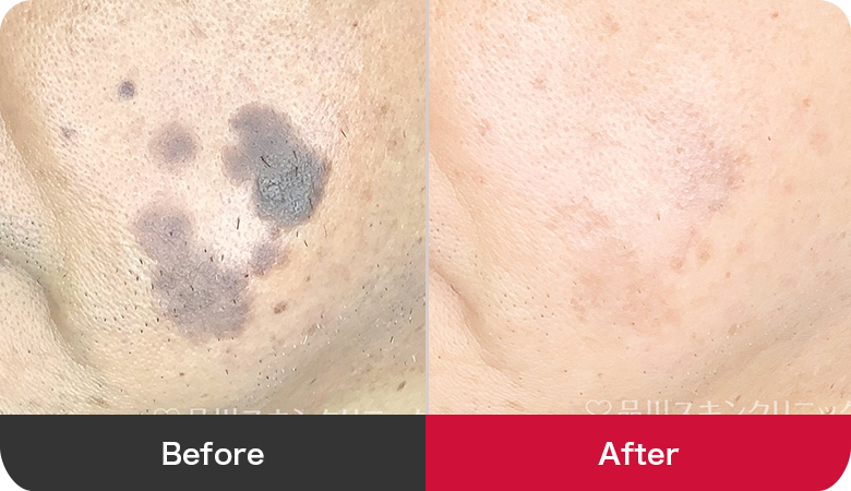 シミ取り治療の症例写真【画像】