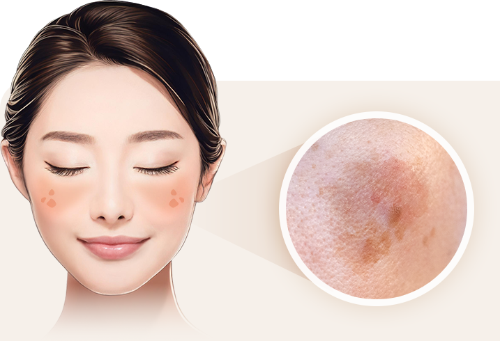 平らな薄いシミ（老人性色素斑）