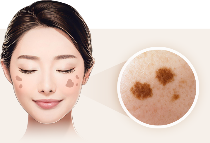 ザラザラ盛り上がったシミ（脂漏性角化症）