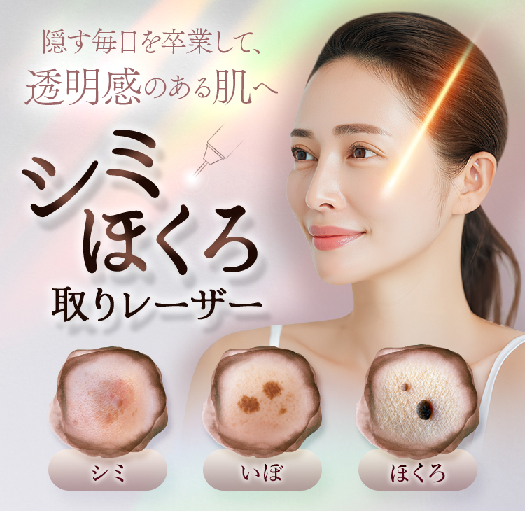 隠す毎日を卒業して、透明感のある肌へ/シミ・ほくろ取りレーザー/シミ/いぼ/ほくろ