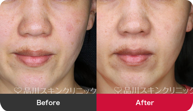 シミ取り治療の症例写真【画像】