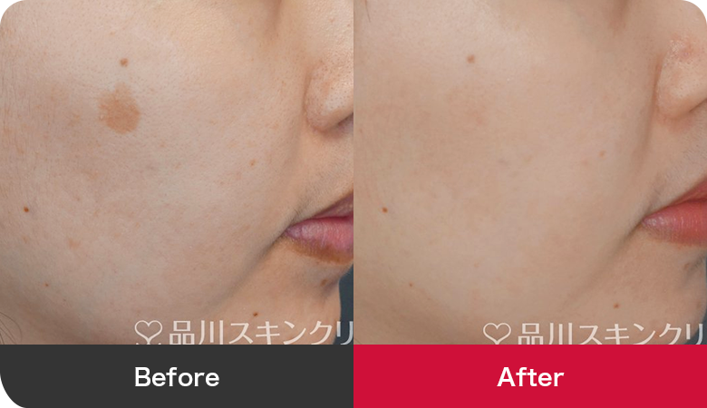 シミ取り治療の症例写真【画像】