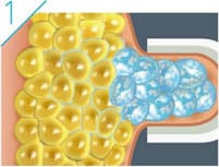 脂肪が気になる部分に専用のアプリケーターを装着し、温度をコントロールしながら一定時間(※)冷却します。【画像】