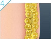 排出された分の脂肪が減ります。ダイエットのように脂肪細胞を小さくするのではなく、脂肪細胞の数自体が減るため、治療後もリバウンドしにくいことが特徴です。【画像】