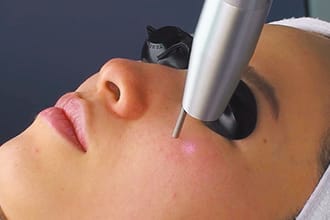 レーザー照射【画像】