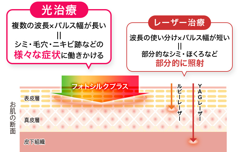光治療（フォトシルクプラス）とレーザー治療はどう違うの？