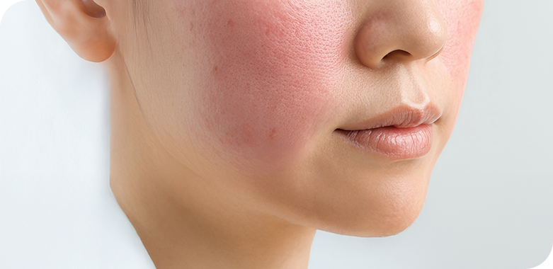 ニキビ跡や赤ら顔改善にも最適