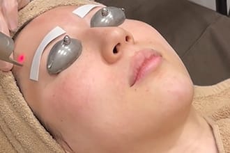 ピコレーザーで治療