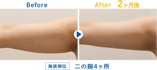 クールスカルプティング 二の腕の症例